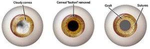 cornealTransplant